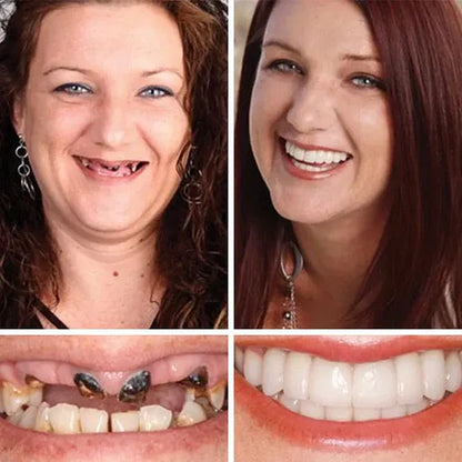 🌎Ends Today: 80% OFF!⏰KLENIMORE™ Custom-Fit Smile Support Kit — Strong Suction Feel & Natural-Looking Fit