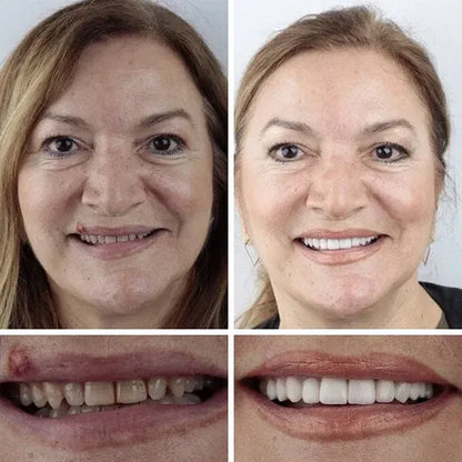 🌎Ends Today: 80% OFF!⏰KLENIMORE™ Custom-Fit Smile Support Kit — Strong Suction Feel & Natural-Looking Fit